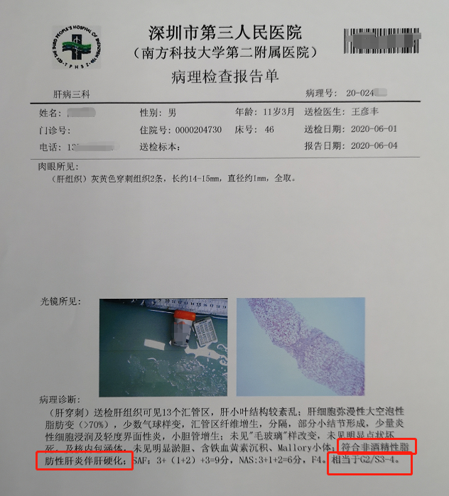 健康时报:11岁肝硬化、12岁脂肪肝,医生提醒,把孩子吃得白白胖胖,其实是害了孩子! 健康时报:11岁肝硬化、12岁脂肪肝,医生提醒,把孩子吃得白白胖胖,其实是害了孩子!